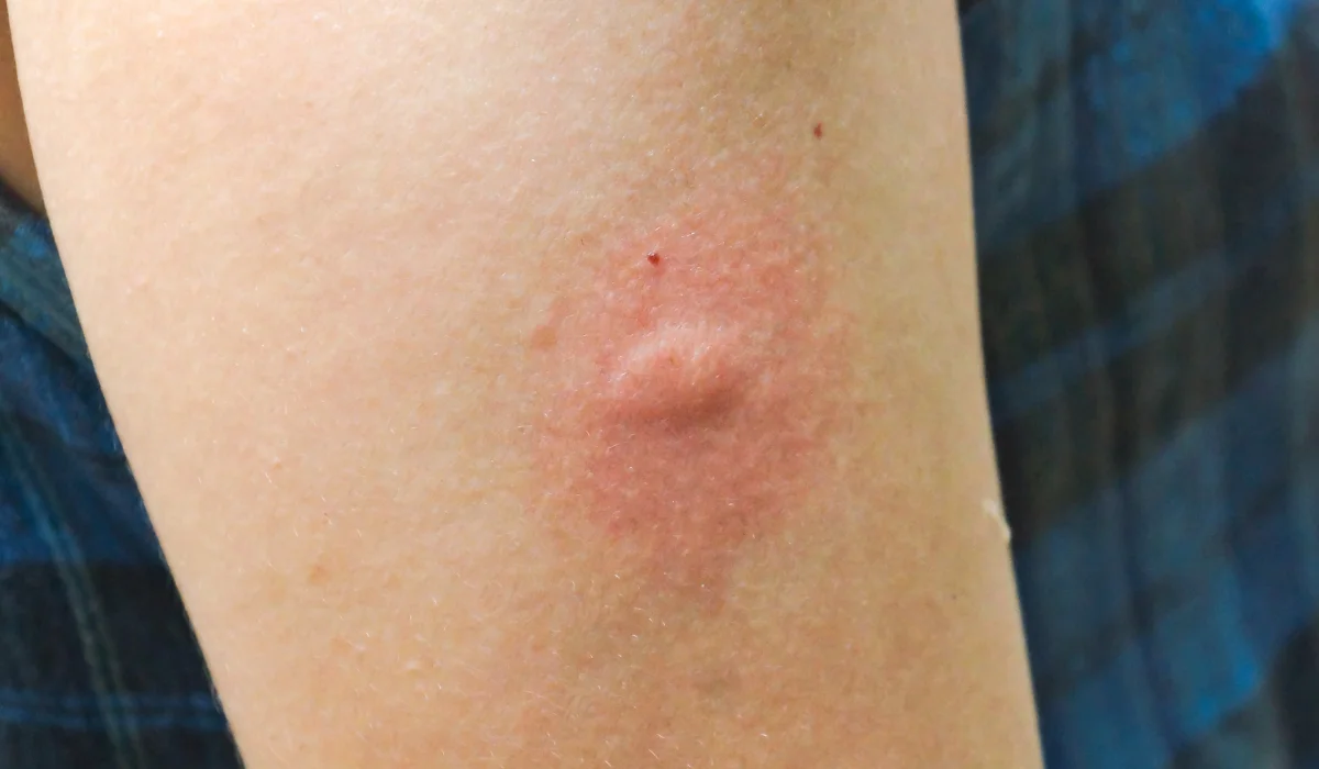 mosquito bite